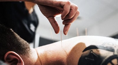 Top 7 Benefits of Acupuncture for Stress and Pain Relief