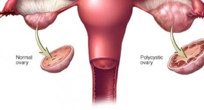 All about PCOS,  symptoms and treatment