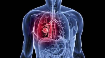 10 Precautionary Measures for Lung Cancer