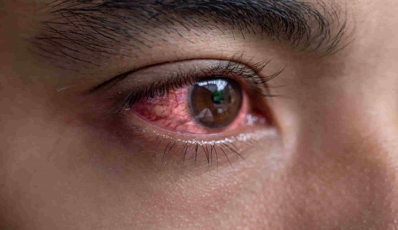 eye-flu-in-rainy-season-symptoms-cure-and-treatments-newstrack