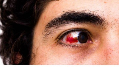 Natural Remedies for Red Eyes: Soothe and Relieve Eye Irritation at Home
