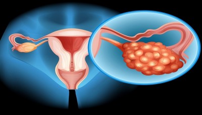 Understanding PCOS, PCOD: Managing Two Common Women's Health Conditions