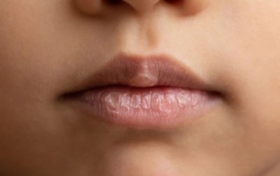 Combat Winter Lip Crust with These Hydration and Lip Care Measures for Pink Lips