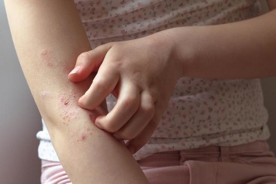 Children's skin has become dry due to dehydration, so follow these home remedies
