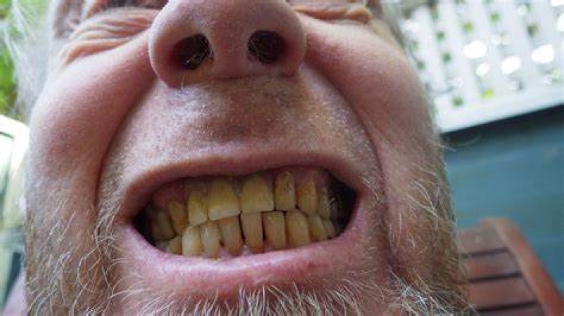 With this home remedy, not a single tooth will break till old age, will remain as strong as iron