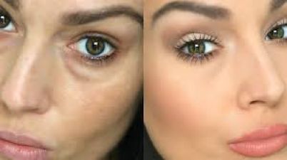 Give glow to your Eyes: Skillful Dealing with under eye dark circles