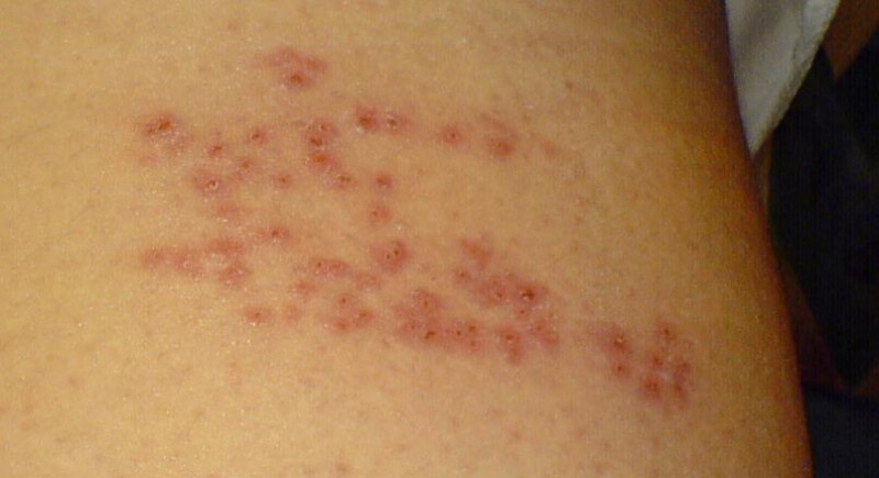 Understanding Shingles: Signs and Treatments