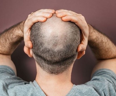 Consumption of These Items Increases the Risk of Baldness: A Significant Revelation in the Study