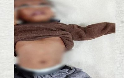 अन्धविश्वास की भेंट चढ़ी ढाई माह की मासूम, 51 बार गर्म लोहे से दागा, अस्पताल में दर्दनाक मौत