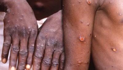 Government issues alert on Monkeypox, know new guidelines