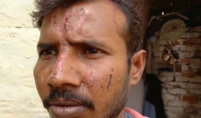 'दबंगों ने दलित युवक के माथे पर तेज़ाब से बना दिया त्रिशूल..', यूपी पुलिस ने किया मामले का Fact Check