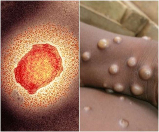 Monkey Pox increases threat, alert issued in this state