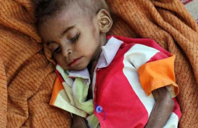 देश में 33 लाख से अधिक बच्चे कुपोषण का शिकार, RTI में हुआ हैरान करने वाला खुलासा