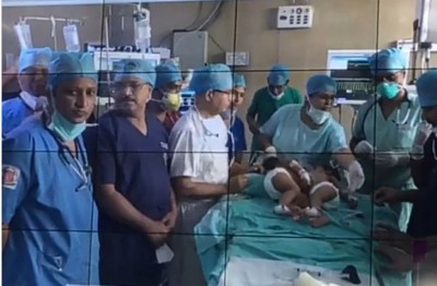 KGMU doctors separate conjoined twins