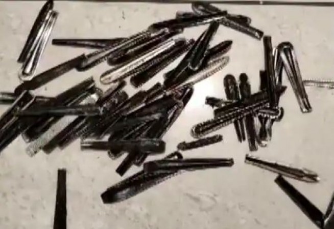 62 spoons of steel removed from young man's stomach, doctors were also surprised