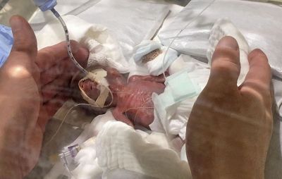 World's smallest baby boy weighing 268 grams sent home healthy
