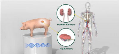 From Pigs to Patients: Unprecedented Success in Transplanting Pig Kidney Fuels Optimism in Medical Community