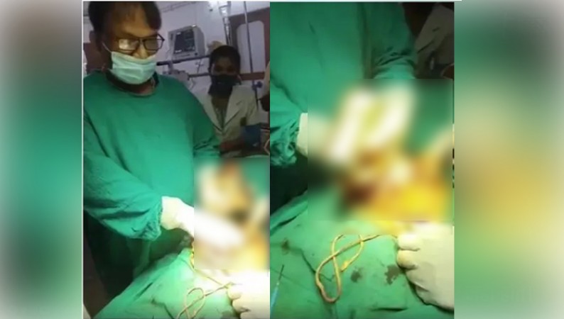 Young man arrives at hospital with severe pain in stomach, doctors remove glass from stomach