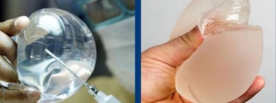 Woman got a breast implant by paying 23 lakhs but the matter got messed up!