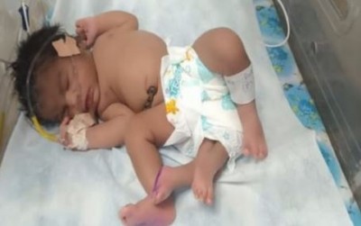 ग्वालियर में जन्मी 4 पैरों वाली बच्ची, तस्वीर हो रही वायरल