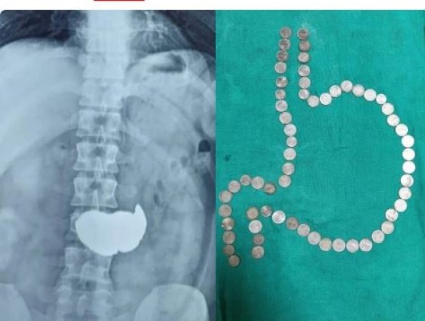 Young man made his stomach a piggy bank, swallowed 63 coins