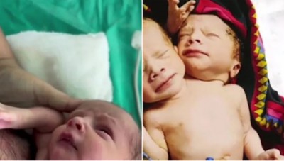 Woman gave birth to unique baby, has two mouths and 3 hands