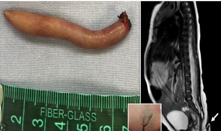 Baby girl born with 5.7 cm long 'Tail,' doctors also shocked