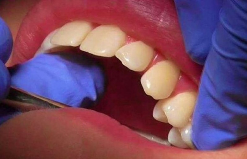 No money to pay the dentist's fees, so woman herself uprooted her 11 teeth