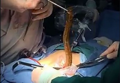 Doctors remove giant fish from man's body, watch video here