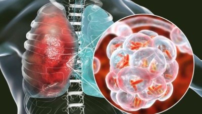 जानिए कब हुई थी निमोनिया के प्रति लोगों के बीच जागरूकता फैलाने की शुरुआत